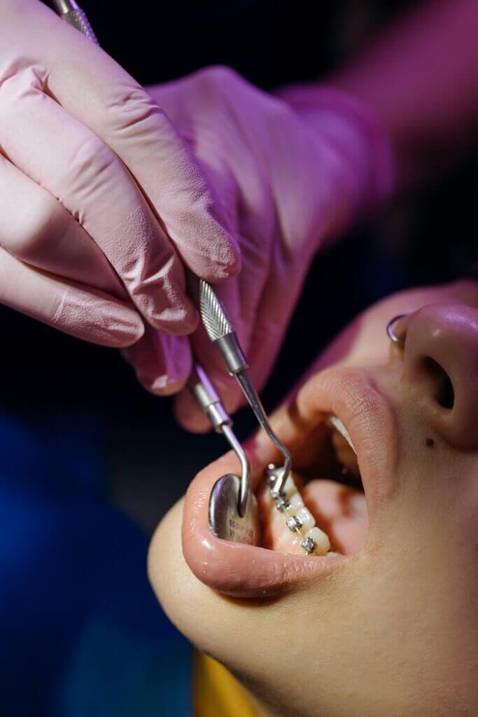 treating-of-a-teeth-with-braces-6528909 Close-up view of a dental examination focusing on braces treatment.